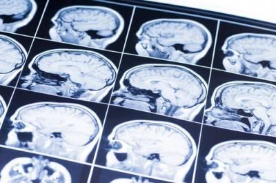 Wisconsin traumatic brain injury lawyers